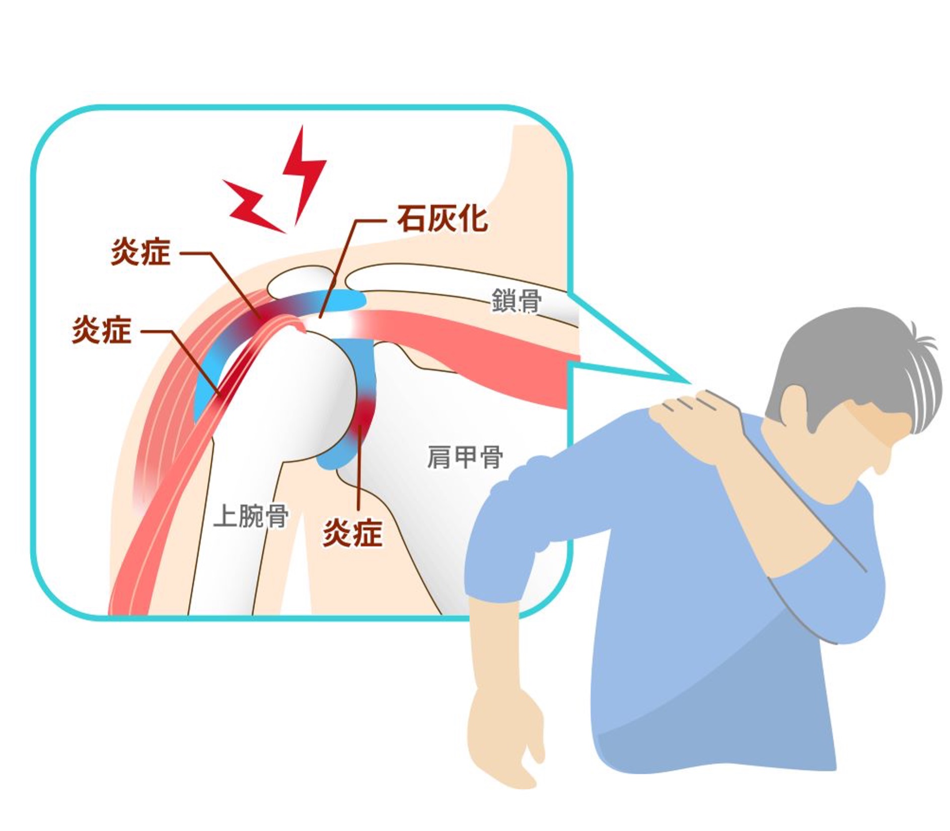 四十肩