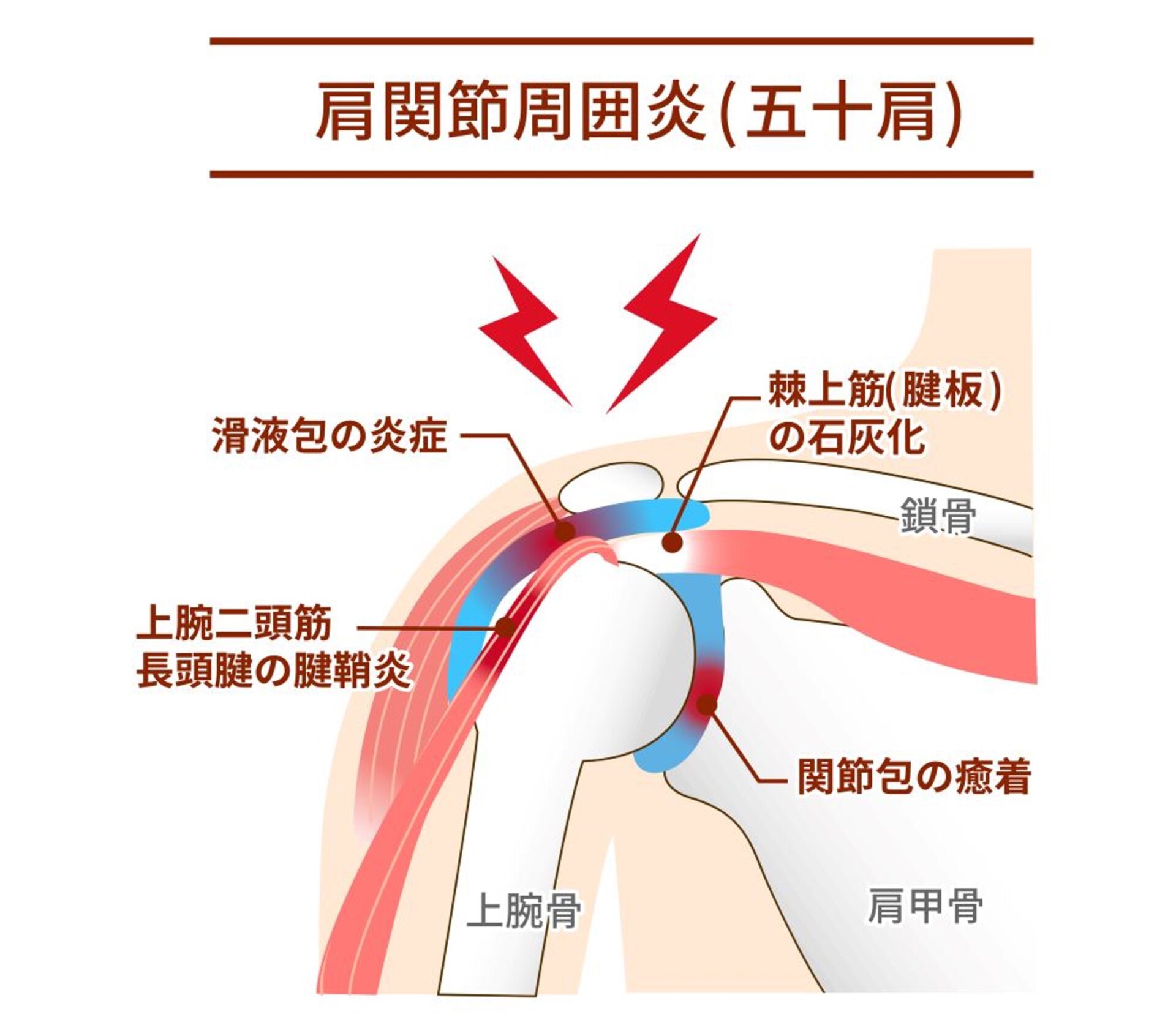 肩関節周囲炎（五十肩）