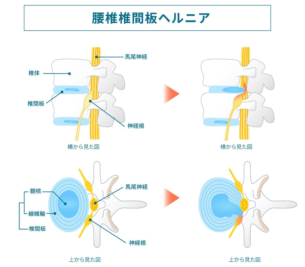 腰椎椎間板ヘルニア
