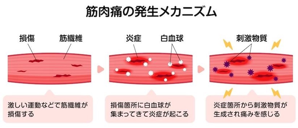 筋肉痛のメカニズム