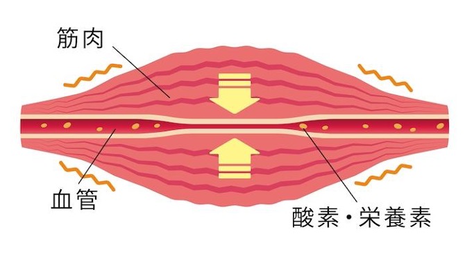 筋肉痛のメカニズム