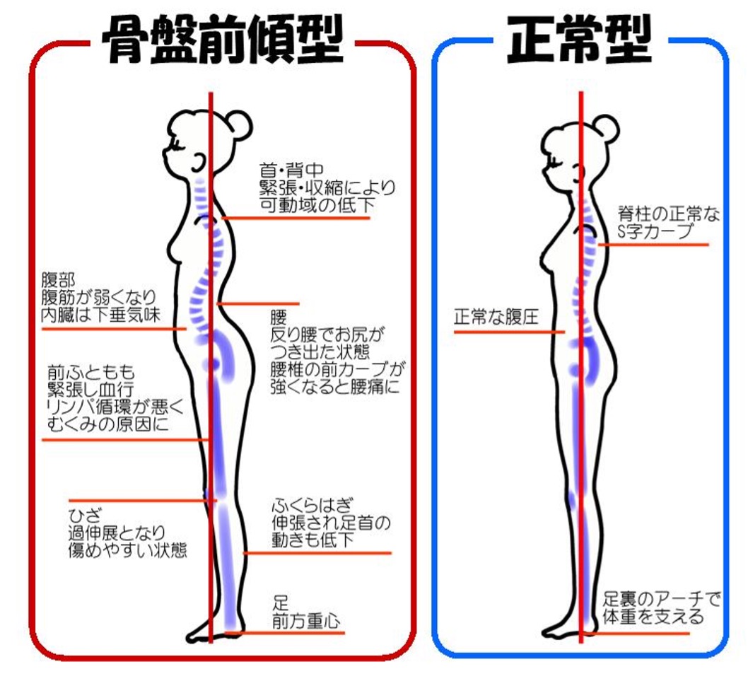 骨盤前傾型と正常型