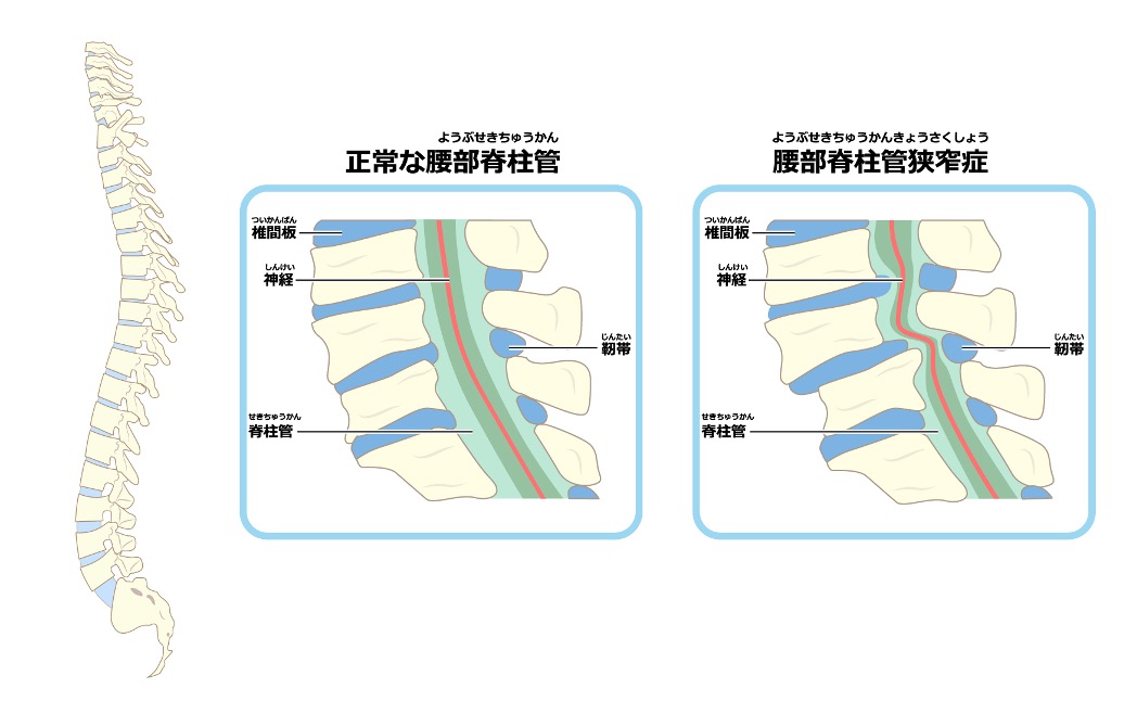 脊柱管狭窄症