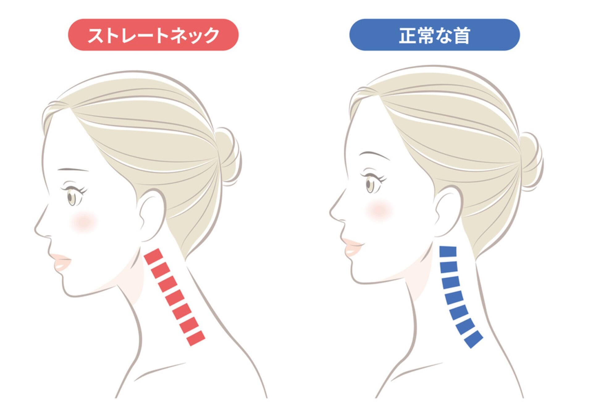 ストレートネックと正常な首