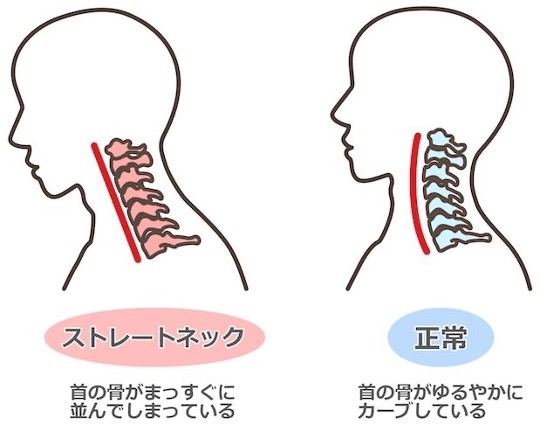 ストレートネック