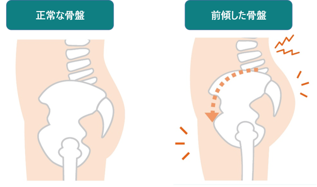 正常な骨盤と前傾した骨盤