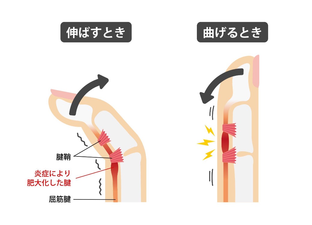 腱鞘炎